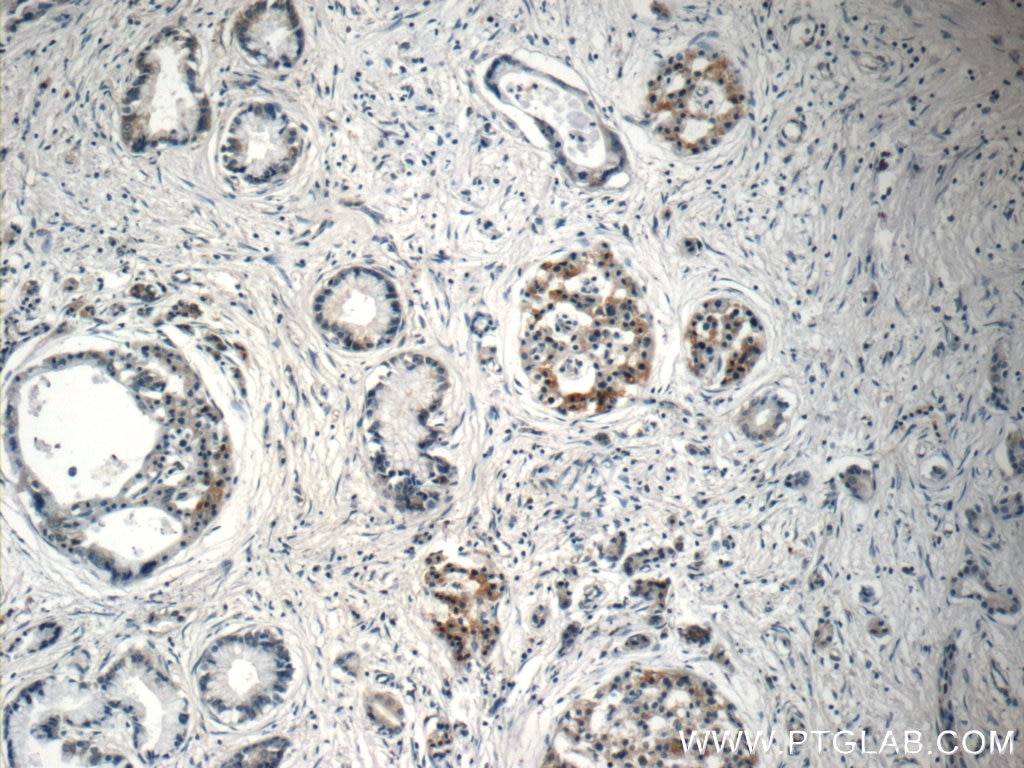 Immunohistochemistry (IHC) staining of human pancreas cancer tissue using EPLIN Polyclonal antibody (16639-1-AP)