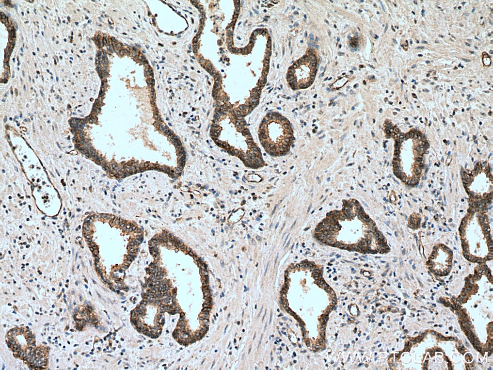 Immunohistochemistry (IHC) staining of human prostate cancer tissue using EPLIN Polyclonal antibody (16639-1-AP)