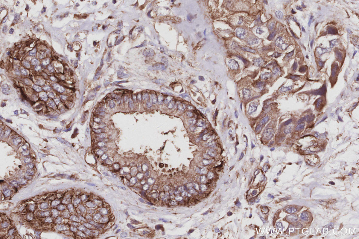 Immunohistochemistry (IHC) staining of human pancreas cancer tissue using EPLIN Polyclonal antibody (16639-1-AP)