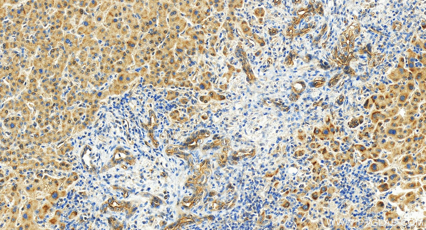 Immunohistochemistry (IHC) staining of human intrahepatic cholangiocarcinoma tissue using LIMCH1 Polyclonal antibody (26561-1-AP)