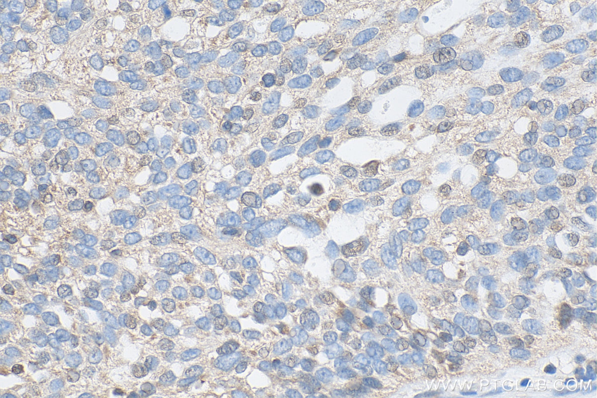 Immunohistochemistry (IHC) staining of human ovary cancer tissue using LIMD2 Polyclonal antibody (15471-1-AP)