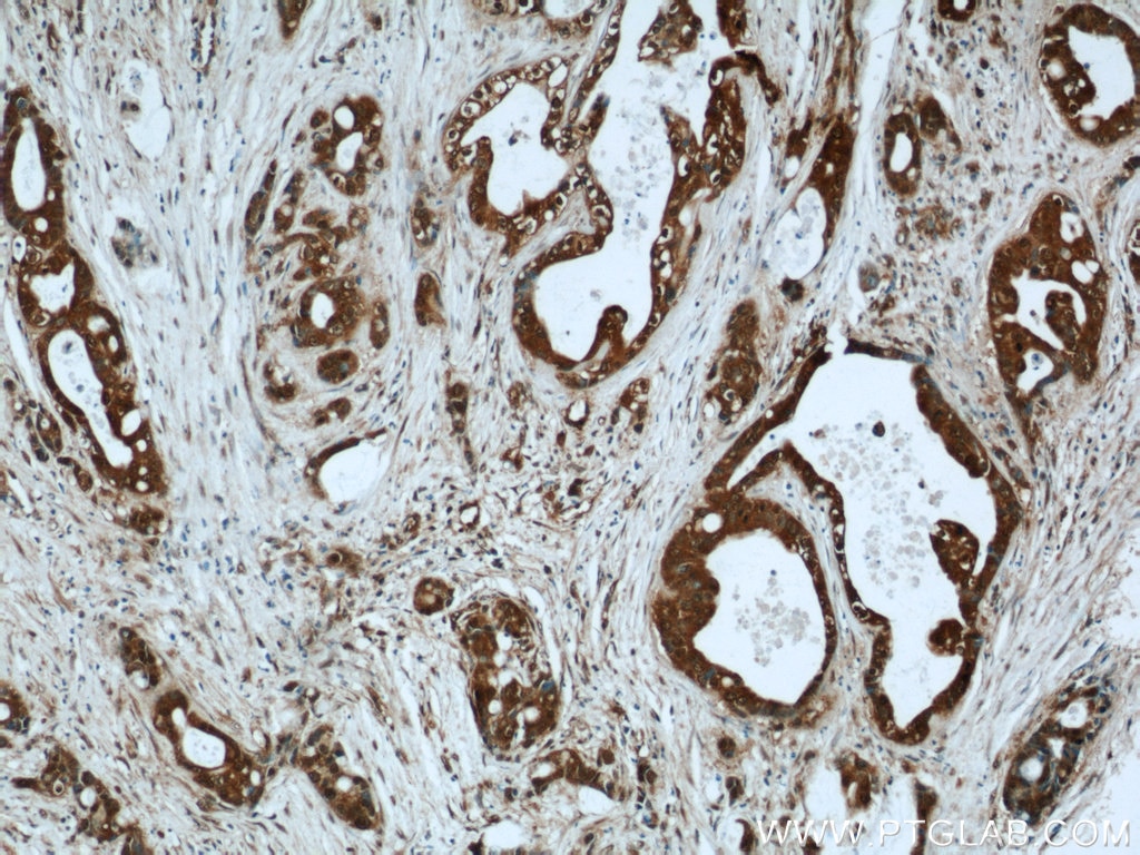 Immunohistochemistry (IHC) staining of human liver cancer tissue using LIMD2 Polyclonal antibody (15471-1-AP)