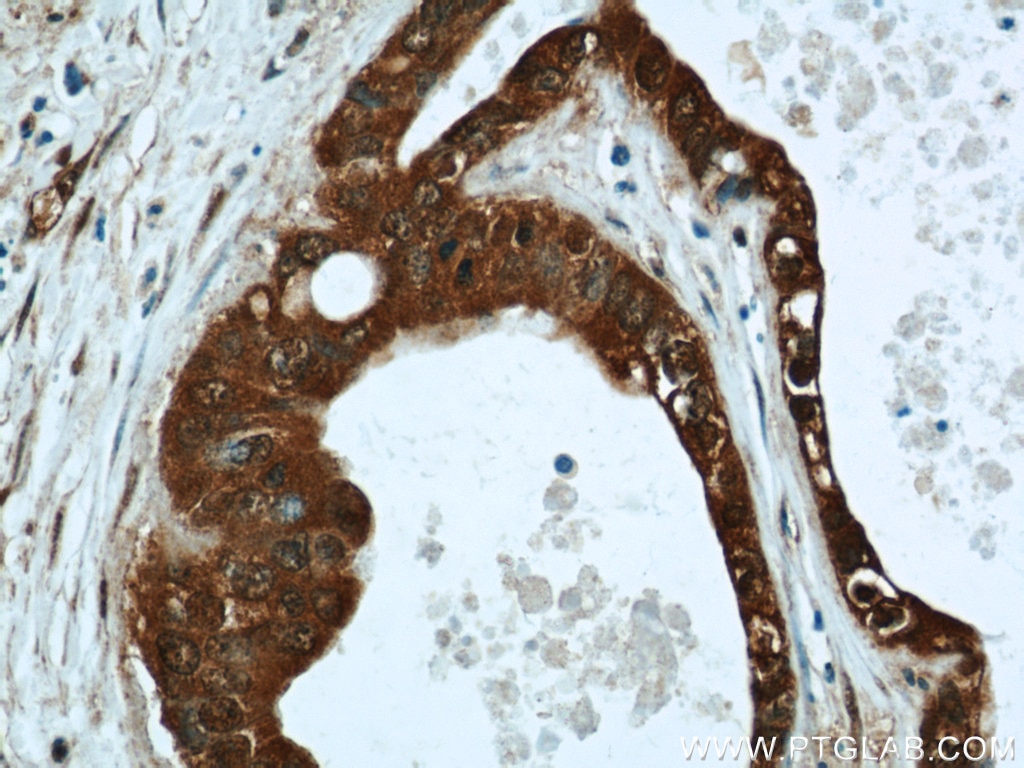 Immunohistochemistry (IHC) staining of human liver cancer tissue using LIMD2 Polyclonal antibody (15471-1-AP)