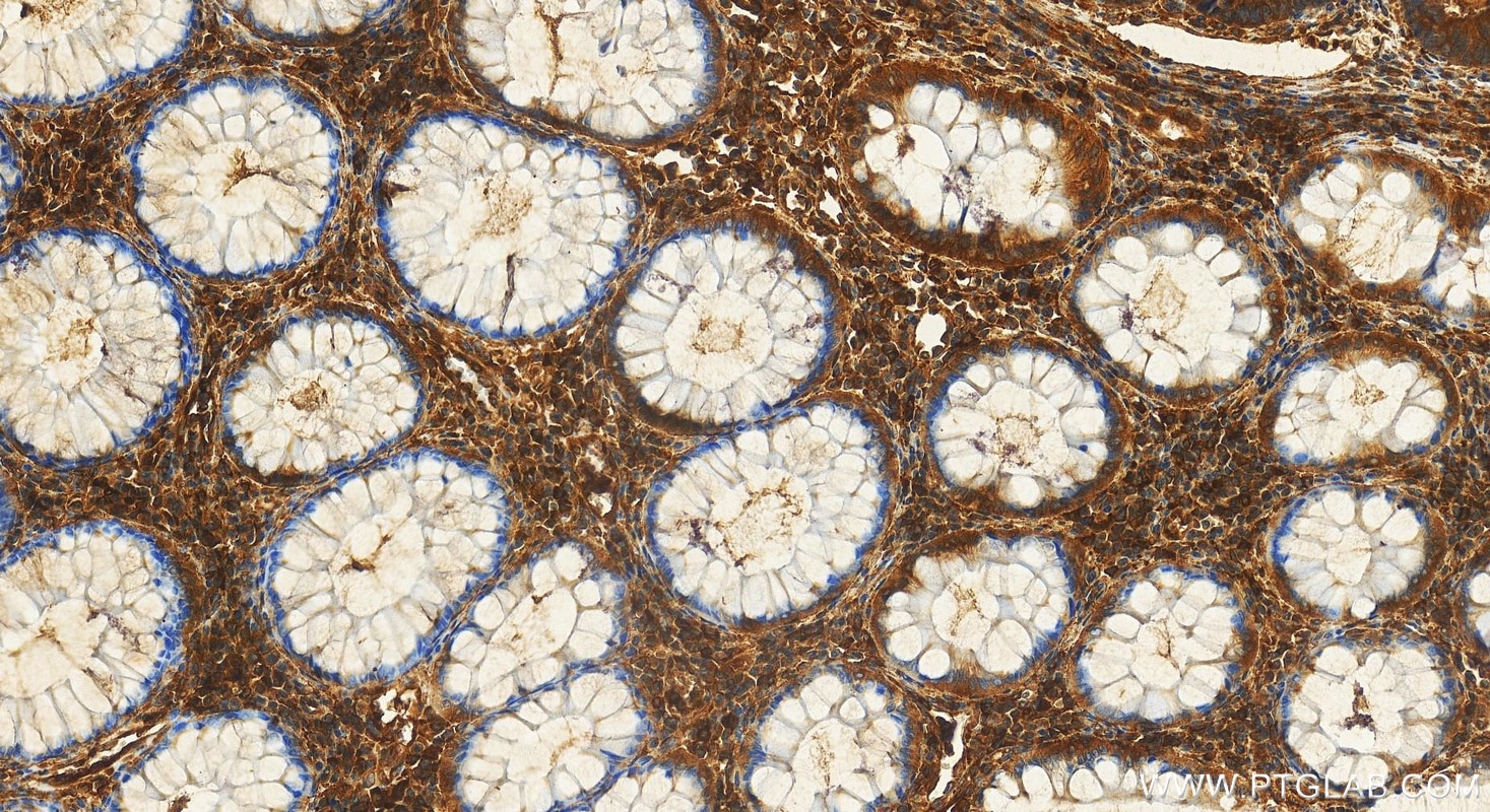 Immunohistochemistry (IHC) staining of human colon cancer tissue using LIMS1 Polyclonal antibody (20772-1-AP)