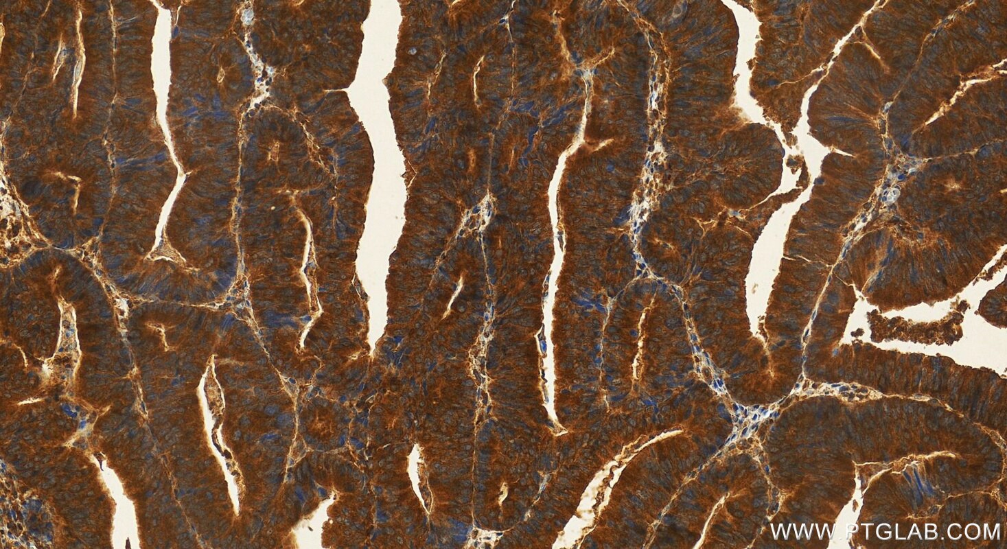 Immunohistochemistry (IHC) staining of human colon cancer tissue using LIMS1 Polyclonal antibody (20772-1-AP)