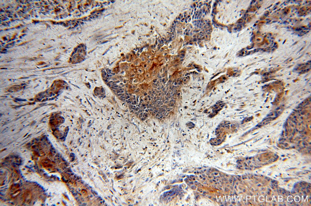 Immunohistochemistry (IHC) staining of human oesophagus cancer tissue using LIMS1 Polyclonal antibody (20772-1-AP)