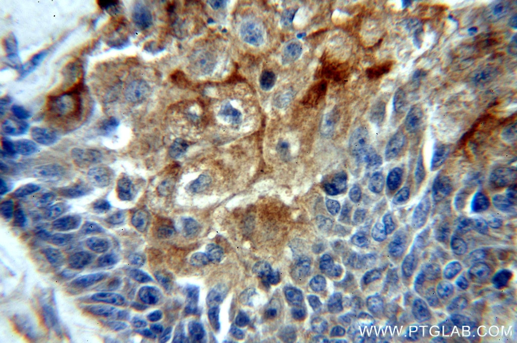 Immunohistochemistry (IHC) staining of human oesophagus cancer tissue using LIMS1 Polyclonal antibody (20772-1-AP)