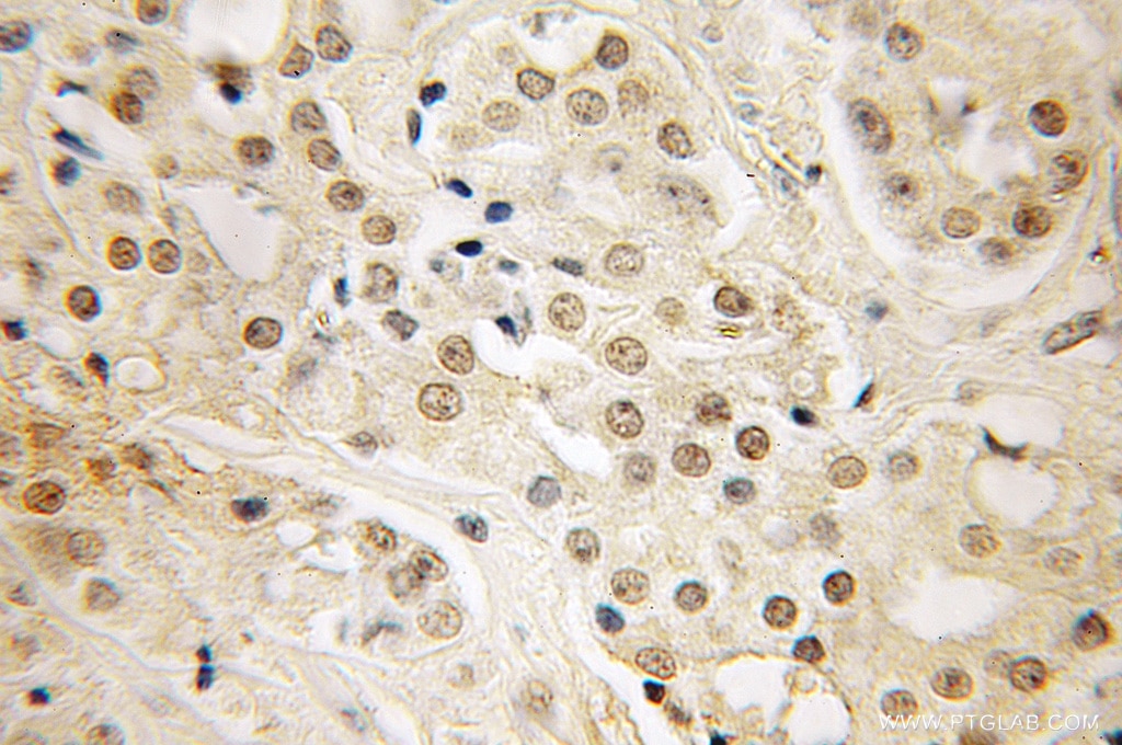 Immunohistochemistry (IHC) staining of human prostate cancer tissue using LIN28 Polyclonal antibody (11724-1-AP)
