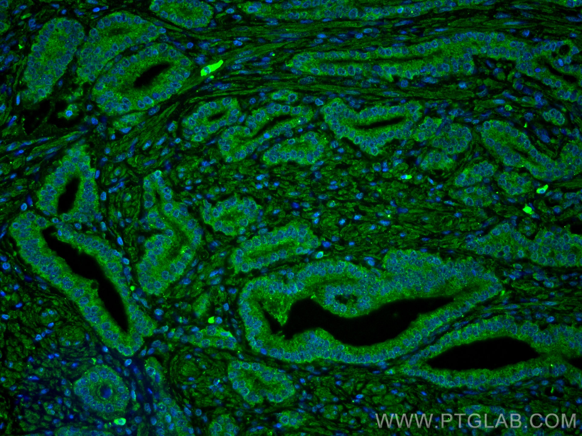 Immunofluorescence (IF) / fluorescent staining of human prostate cancer tissue using LIN28 Monoclonal antibody (60344-1-Ig)