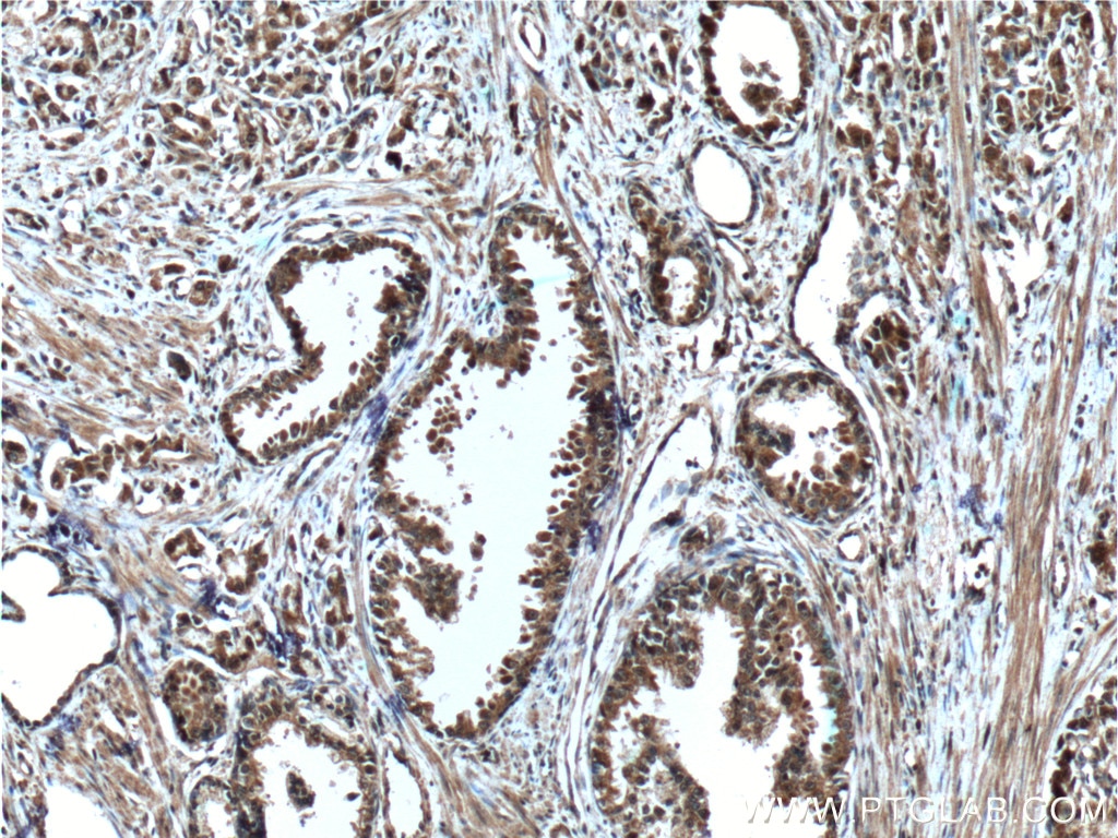 Immunohistochemistry (IHC) staining of human prostate cancer tissue using LIN28 Monoclonal antibody (60344-1-Ig)