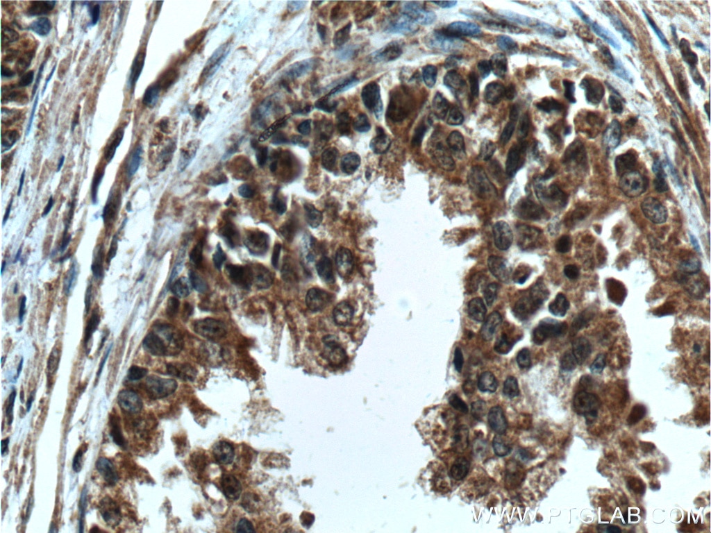 Immunohistochemistry (IHC) staining of human prostate cancer tissue using LIN28 Monoclonal antibody (60344-1-Ig)