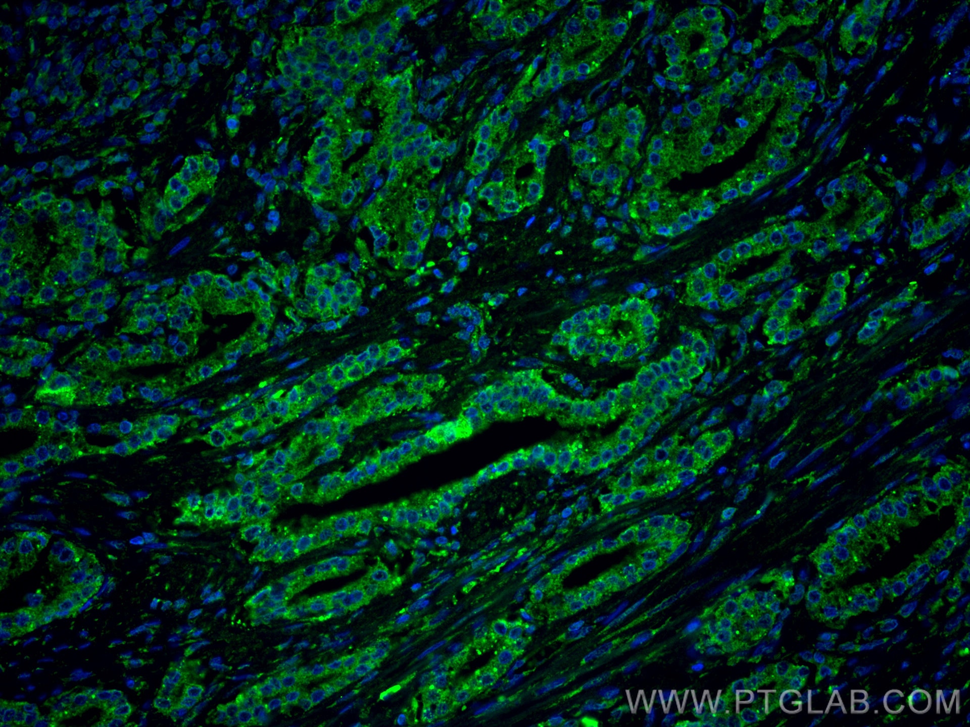 Immunofluorescence (IF) / fluorescent staining of human prostate cancer tissue using CoraLite® Plus 488-conjugated LIN28 Monoclonal ant (CL488-60344)