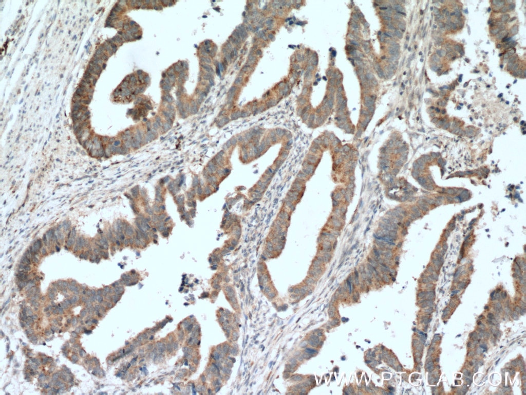 Immunohistochemistry (IHC) staining of human colon cancer tissue using LIPA Polyclonal antibody (12956-1-AP)