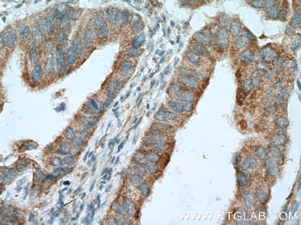 Immunohistochemistry (IHC) staining of human colon cancer tissue using LIPA Polyclonal antibody (12956-1-AP)