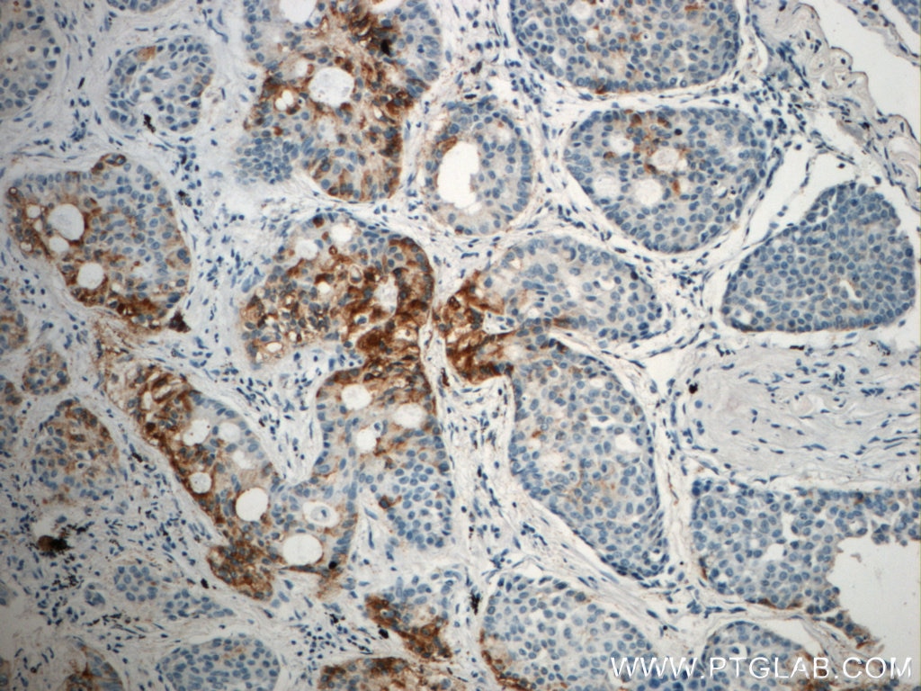 Immunohistochemistry (IHC) staining of human lung cancer tissue using LIPC Polyclonal antibody (21133-1-AP)