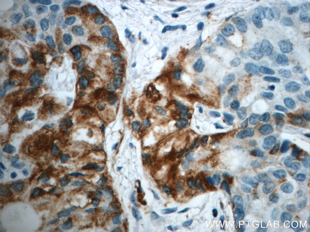 Immunohistochemistry (IHC) staining of human lung cancer tissue using LIPC Polyclonal antibody (21133-1-AP)