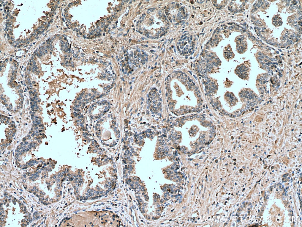 Immunohistochemistry (IHC) staining of human prostate cancer tissue using LIPG Monoclonal antibody (67434-1-Ig)