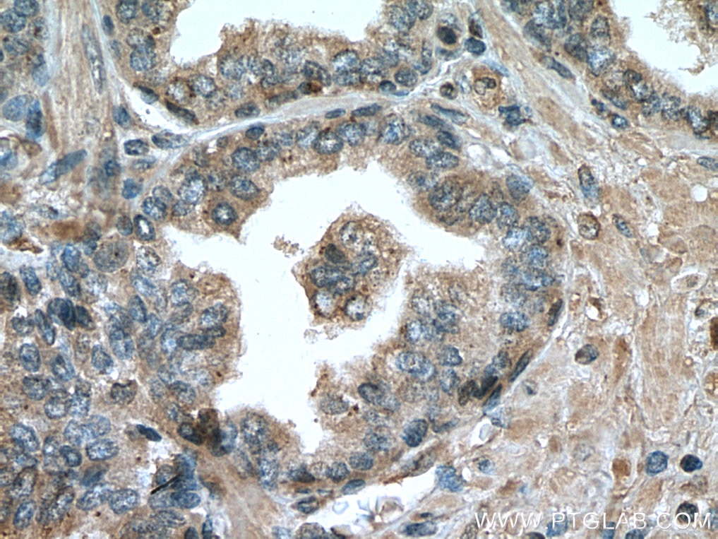 Immunohistochemistry (IHC) staining of human prostate cancer tissue using LIPG Monoclonal antibody (67434-1-Ig)