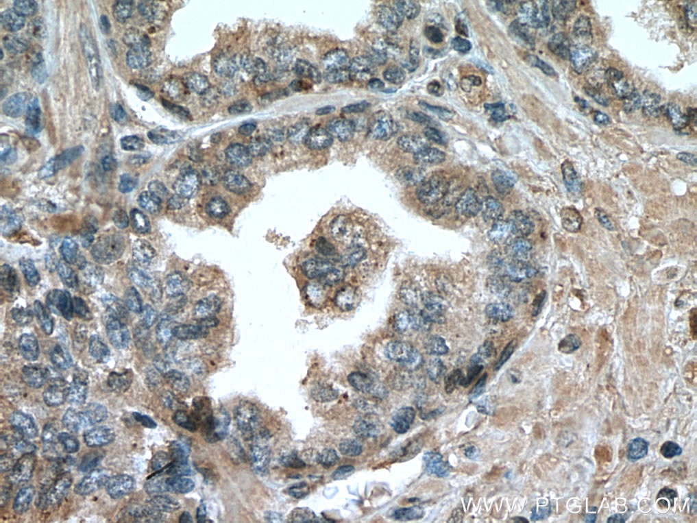 IHC staining of human prostate cancer using 67434-1-Ig