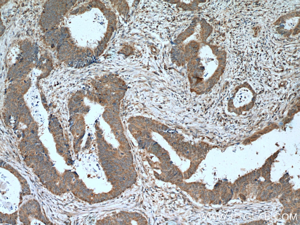 Immunohistochemistry (IHC) staining of human colon cancer tissue using LIPH Monoclonal antibody (66303-1-Ig)