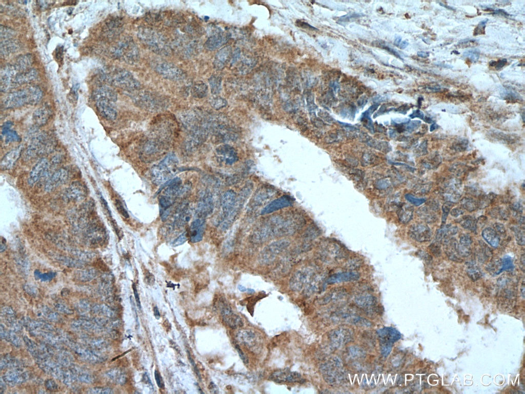 Immunohistochemistry (IHC) staining of human colon cancer tissue using LIPH Monoclonal antibody (66303-1-Ig)