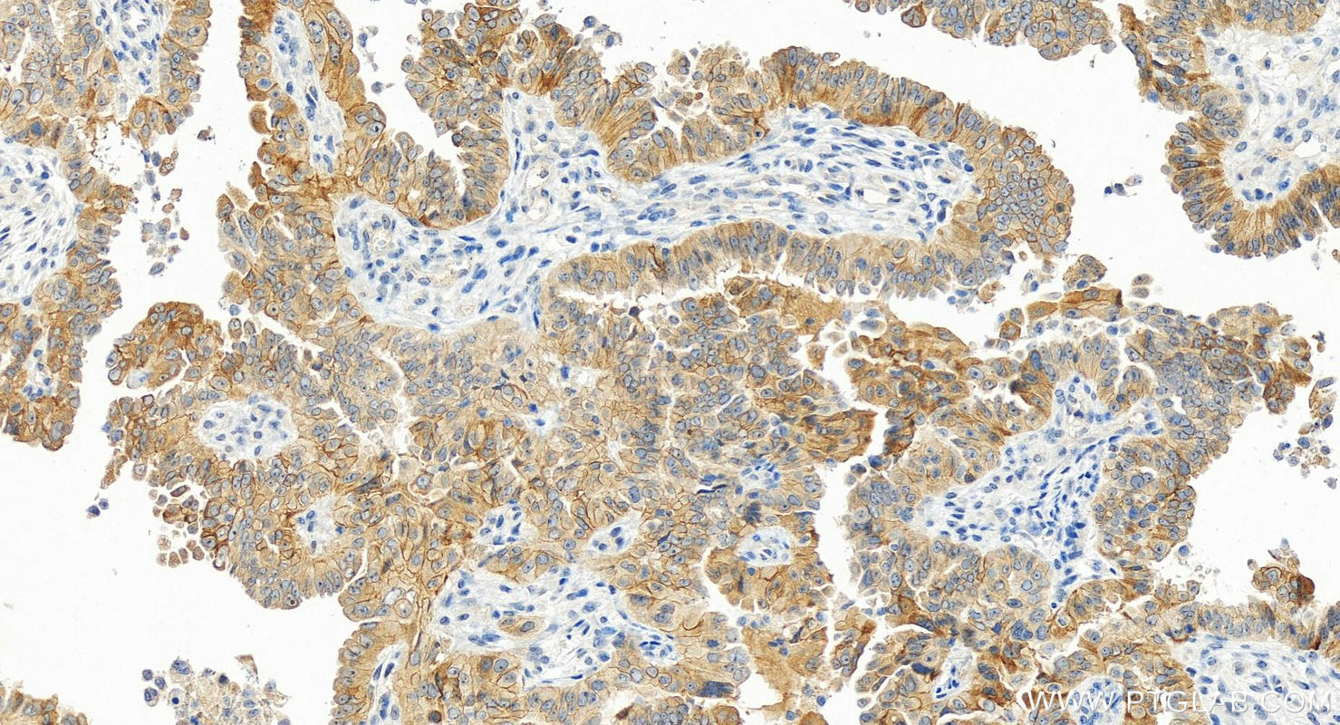 Immunohistochemical analysis of paraffin-embedded human ovarian cancer slide using 15993-1-AP (LLGL2 antibody) at dilution of 1:400 (under 20x lens). Heat mediated antigen retrieval with Tris-EDTA buffer (pH 9.0). Immunohistochemistry (IHC) staining of human ovarian cancer using LLGL2 Polyclonal antibody (15993-1-AP)