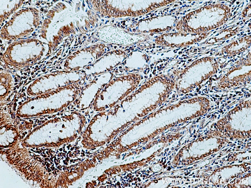 Immunohistochemistry (IHC) staining of human stomach cancer tissue using ERGIC-53 Polyclonal antibody (13364-1-AP)