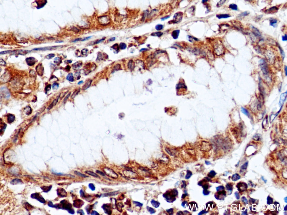 Immunohistochemistry (IHC) staining of human stomach cancer tissue using ERGIC-53 Polyclonal antibody (13364-1-AP)