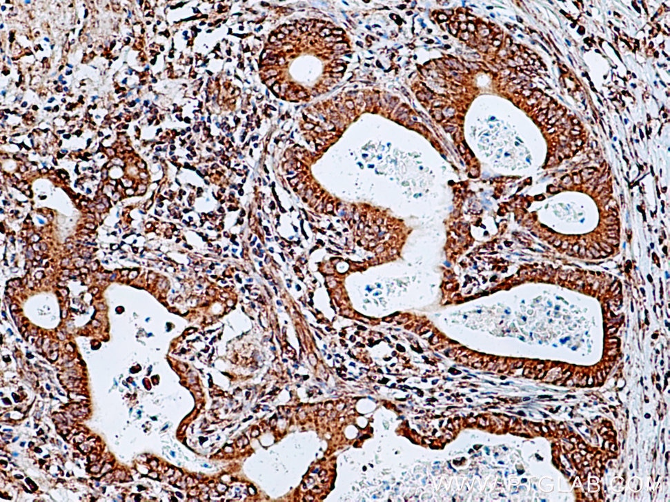 IHC staining of human stomach cancer using 13364-1-AP