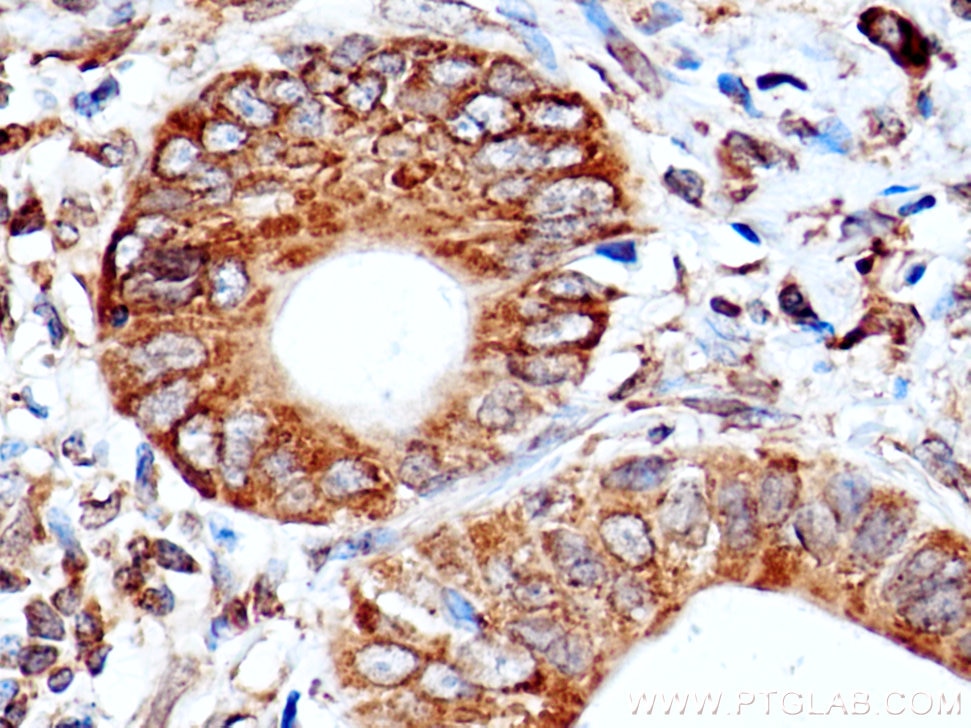 IHC staining of human stomach cancer using 13364-1-AP