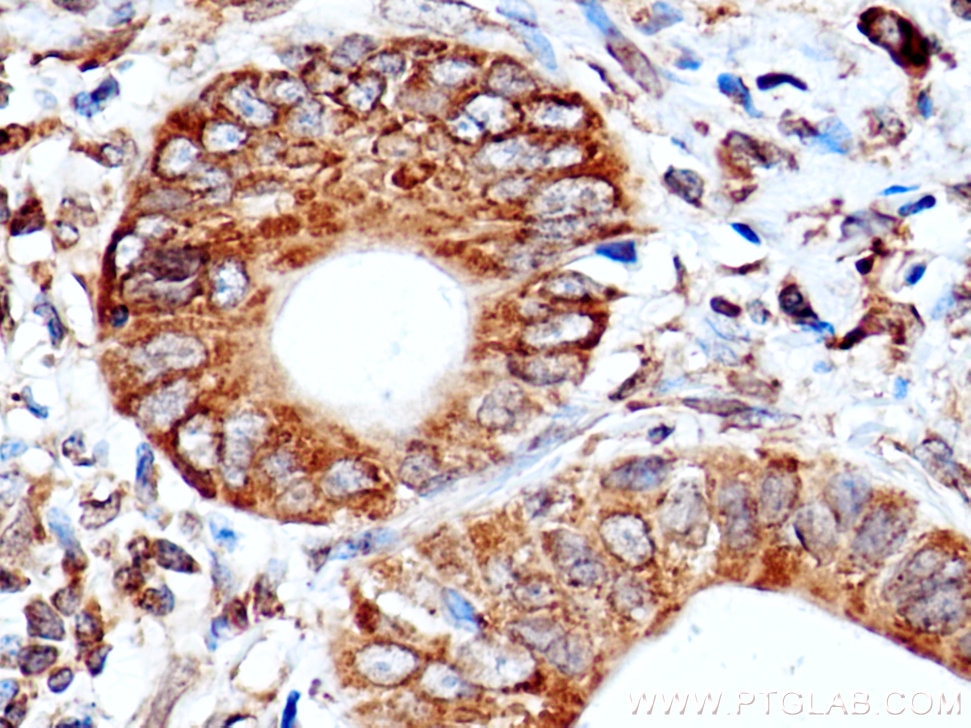 Immunohistochemistry (IHC) staining of human stomach cancer tissue using ERGIC-53 Polyclonal antibody (13364-1-AP)