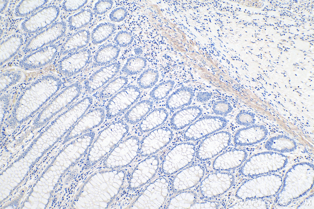 IHC staining of human colon cancer using 67834-1-Ig