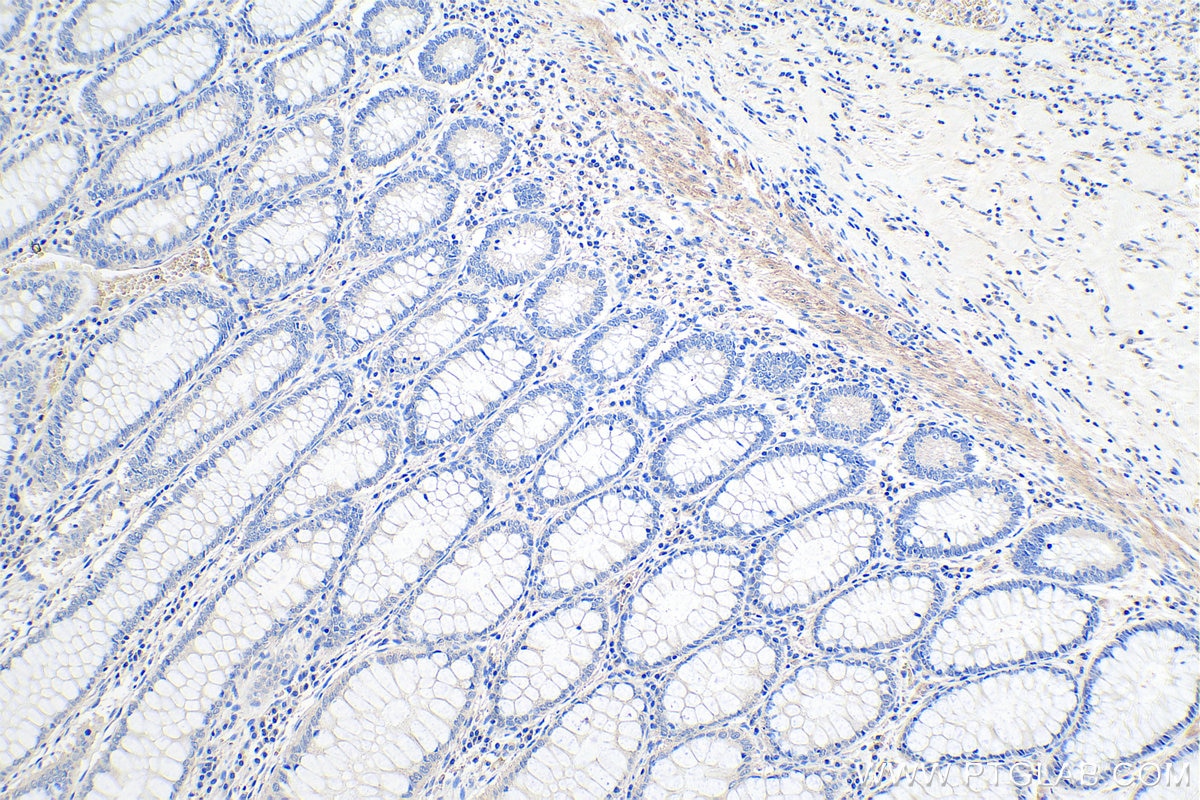 Immunohistochemistry (IHC) staining of human colon cancer tissue using LMCD1 Monoclonal antibody (67834-1-Ig)