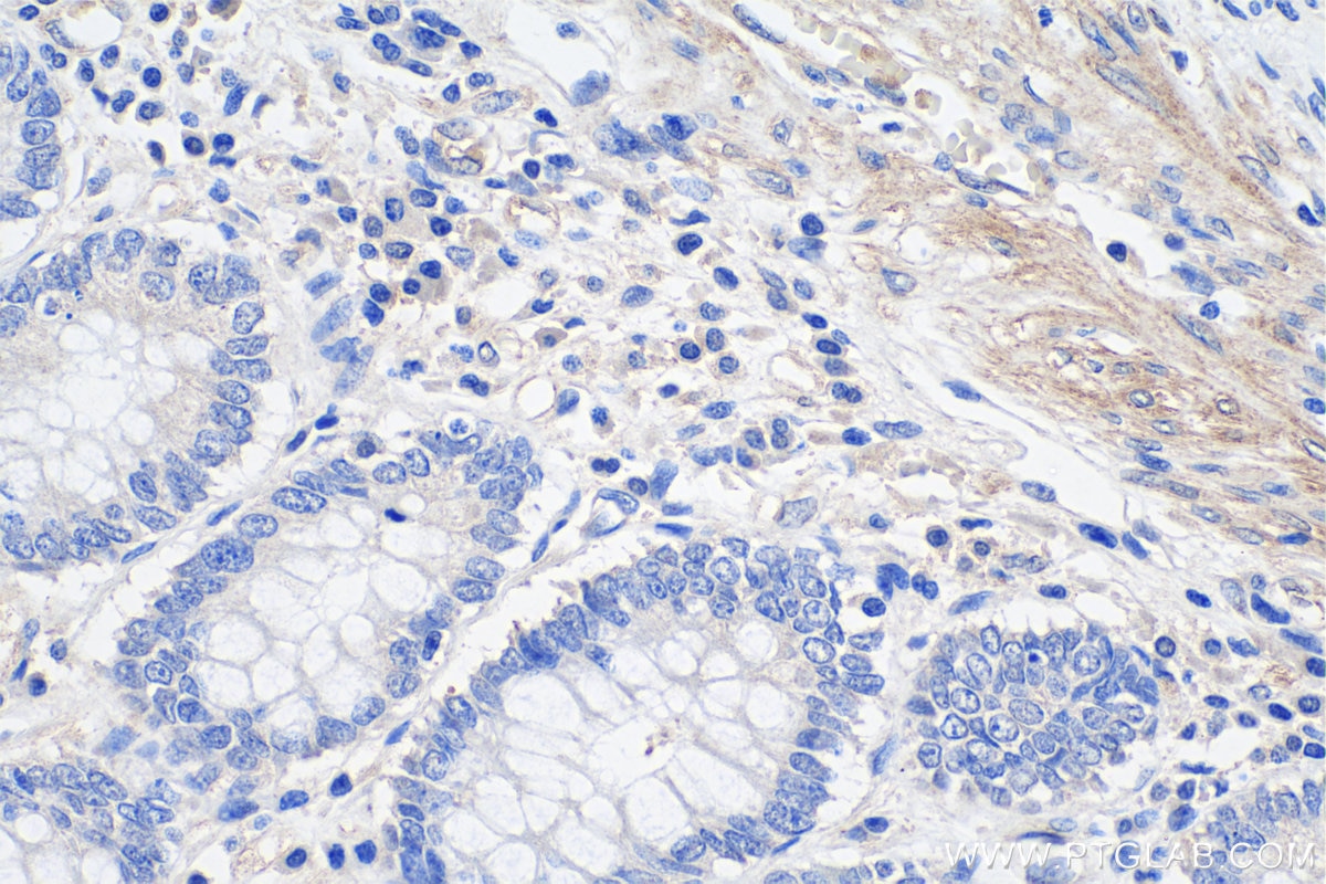 Immunohistochemistry (IHC) staining of human colon cancer tissue using LMCD1 Monoclonal antibody (67834-1-Ig)