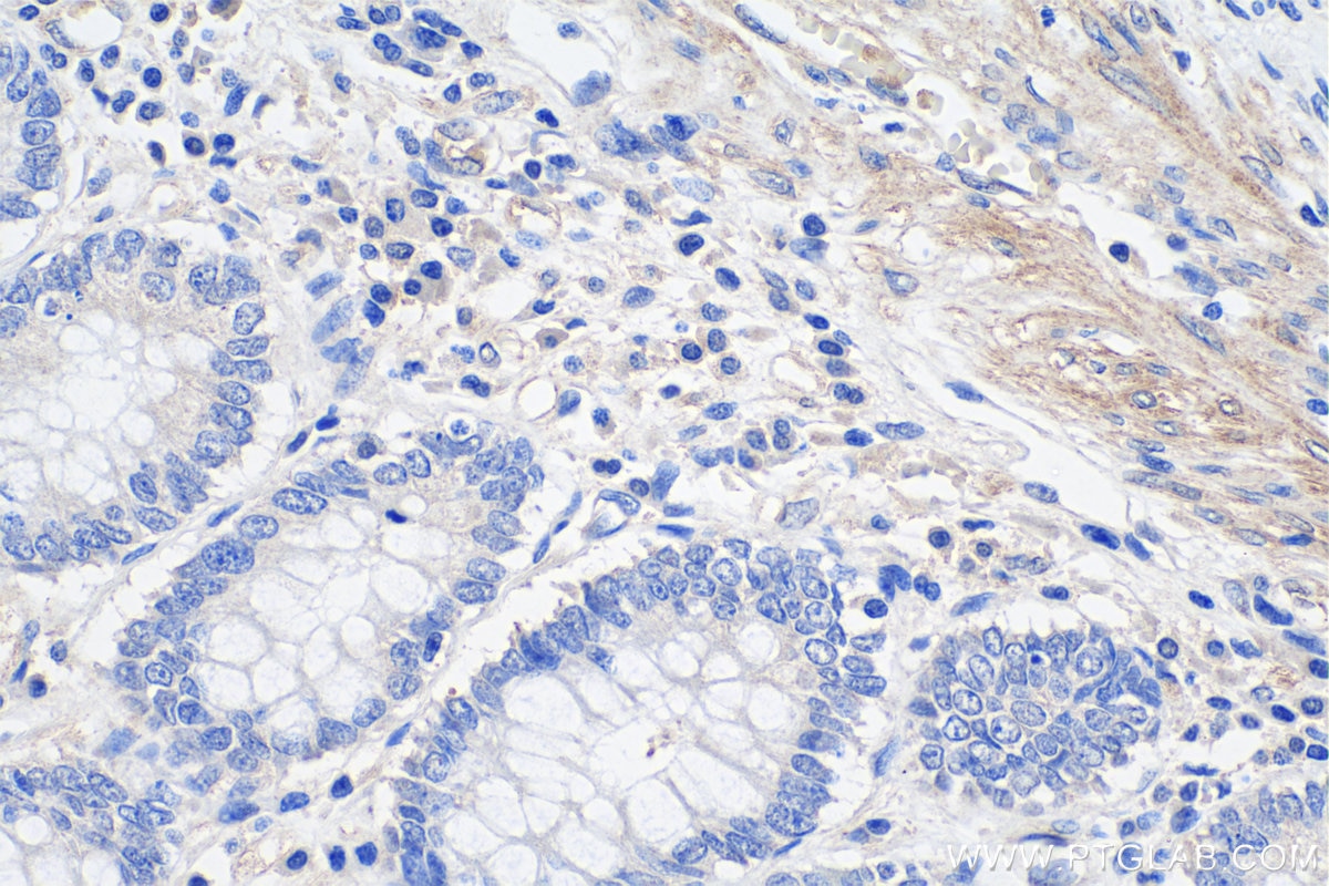 IHC staining of human colon cancer using 67834-1-Ig