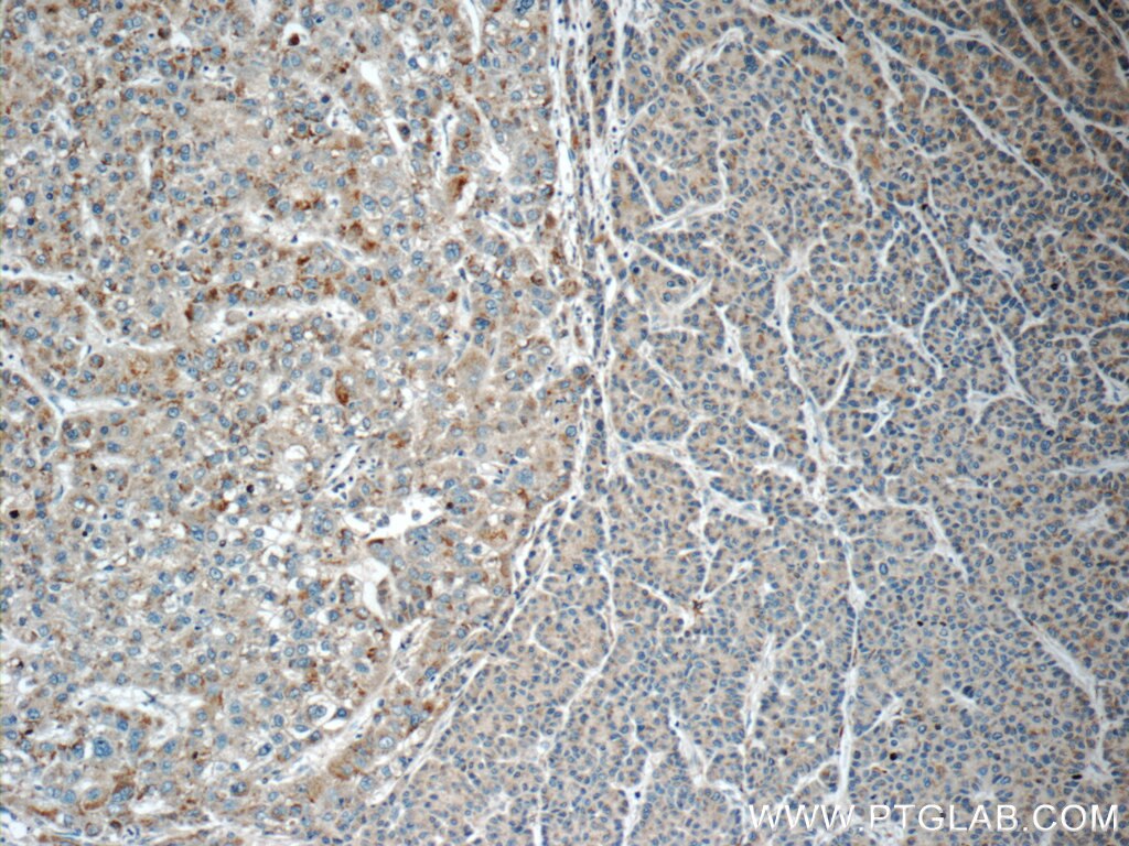 Immunohistochemistry (IHC) staining of human liver cancer tissue using LMF1 Polyclonal antibody (16812-1-AP)