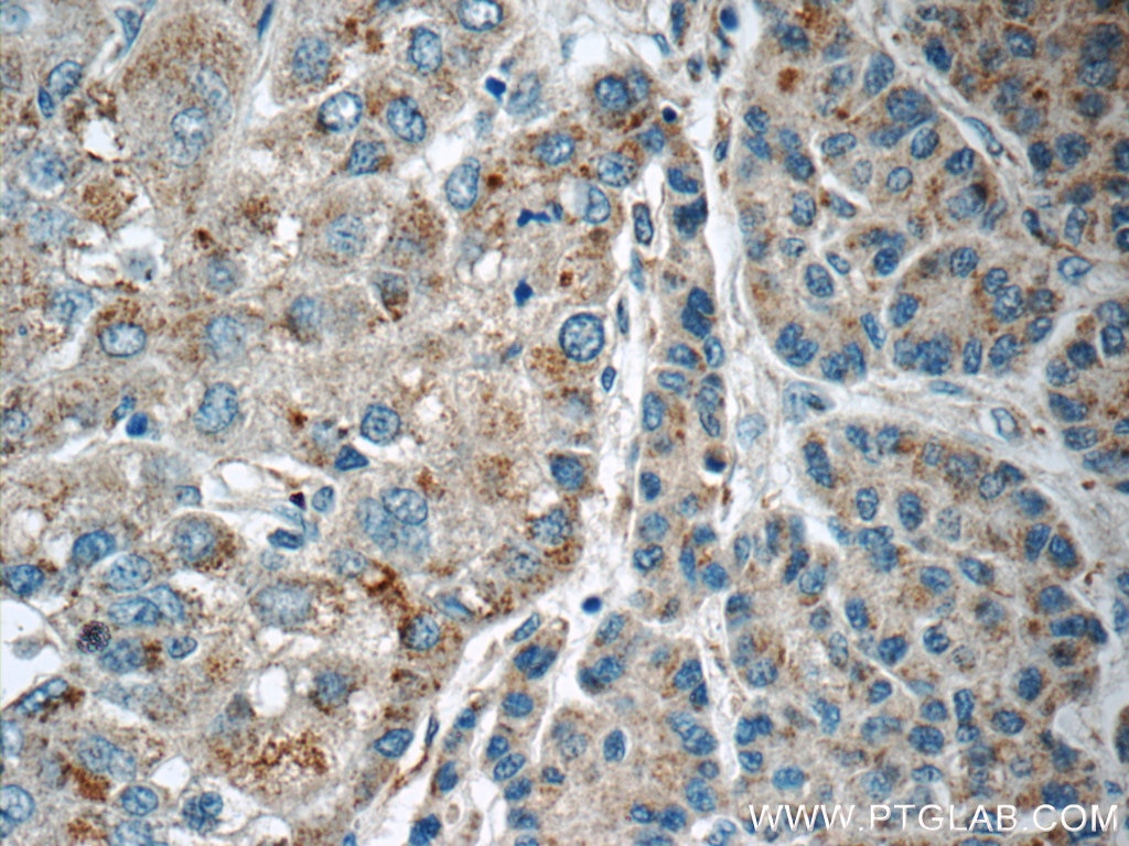 Immunohistochemistry (IHC) staining of human liver cancer tissue using LMF1 Polyclonal antibody (16812-1-AP)
