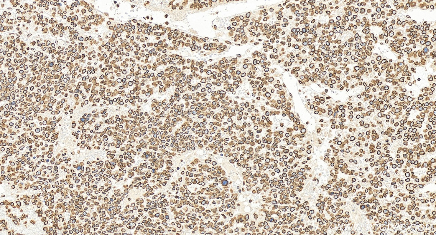 Immunohistochemical analysis of paraffin-embedded human hepatocellular carcinoma slide using 12987-1-AP (Lamin B1 antibody) at dilution of 1:2000 (under 20x lens). Heat mediated antigen retrieval with Sodium Citrate buffer (pH 6.0). Immunohistochemistry (IHC) staining of human hepatocellular carcinoma using Lamin B1 Polyclonal antibody (12987-1-AP)