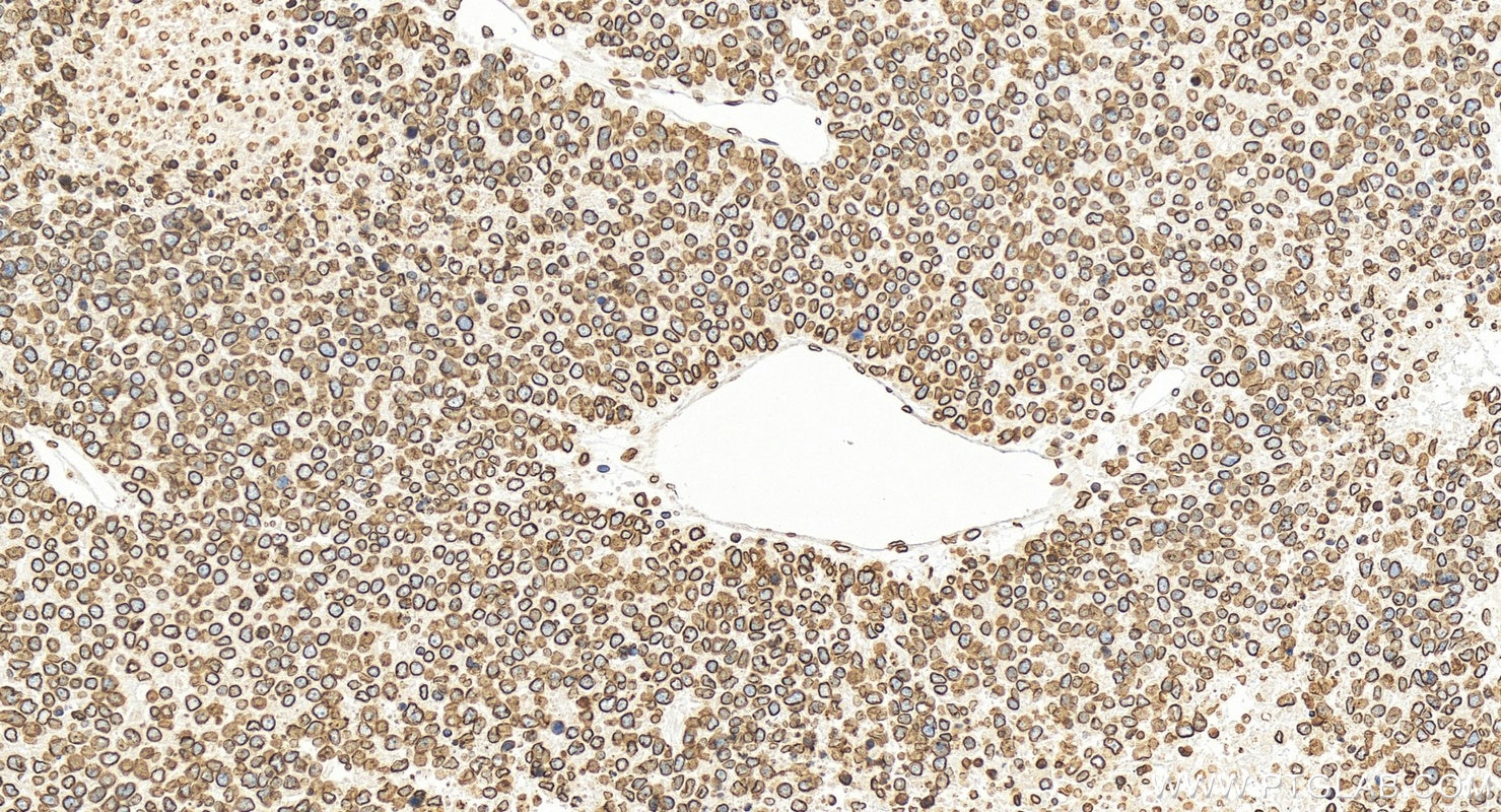 Immunohistochemical analysis of paraffin-embedded human hepatocellular carcinoma slide using 12987-1-AP (Lamin B1 antibody) at dilution of 1:2000 (under 20x lens). Heat mediated antigen retrieval with Sodium Citrate buffer (pH 6.0). Immunohistochemistry (IHC) staining of human hepatocellular carcinoma using Lamin B1 Polyclonal antibody (12987-1-AP)