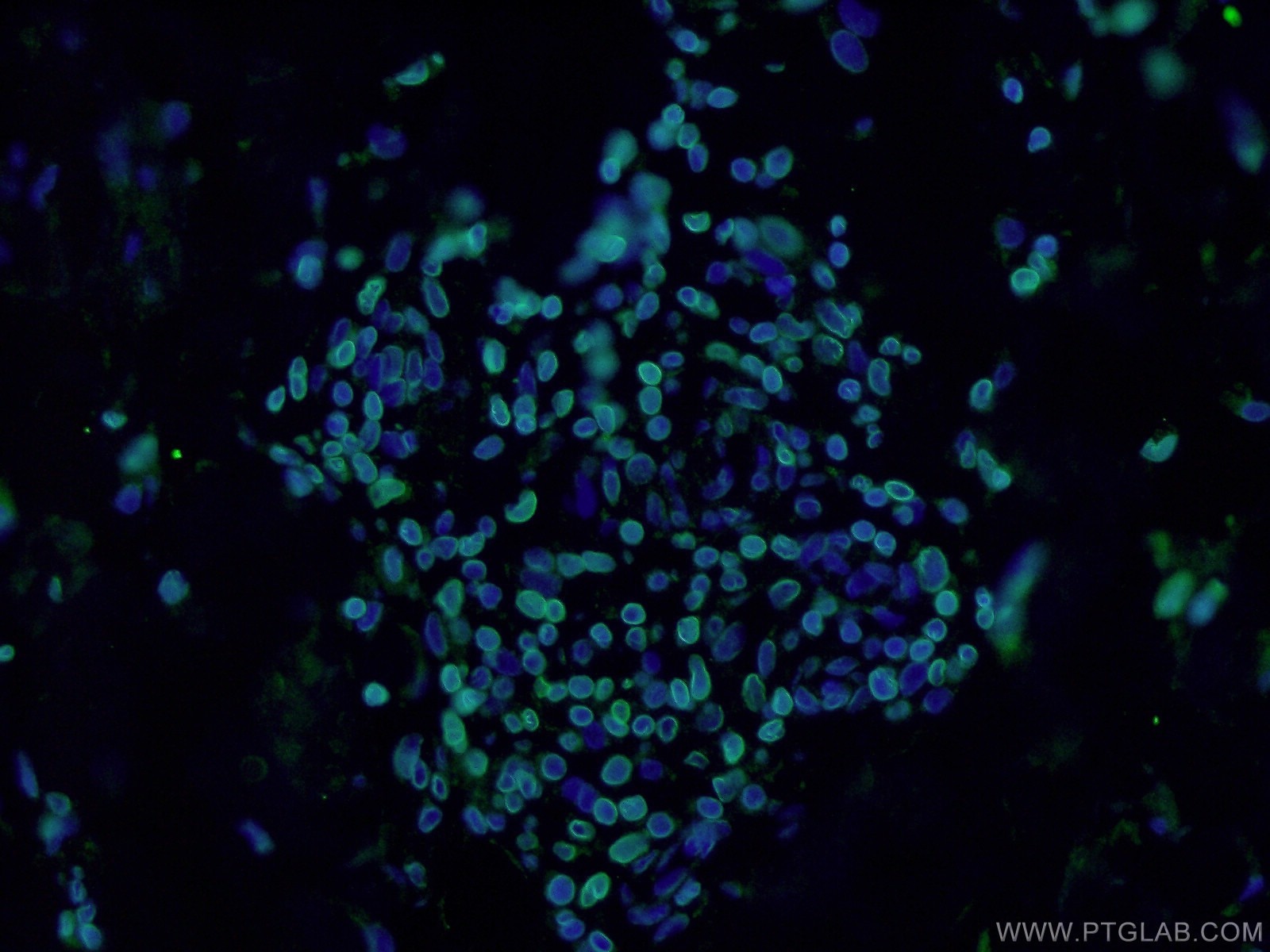 Immunofluorescence (IF) / fluorescent staining of human skin cancer tissue using Lamin B1 Polyclonal antibody (12987-1-AP)