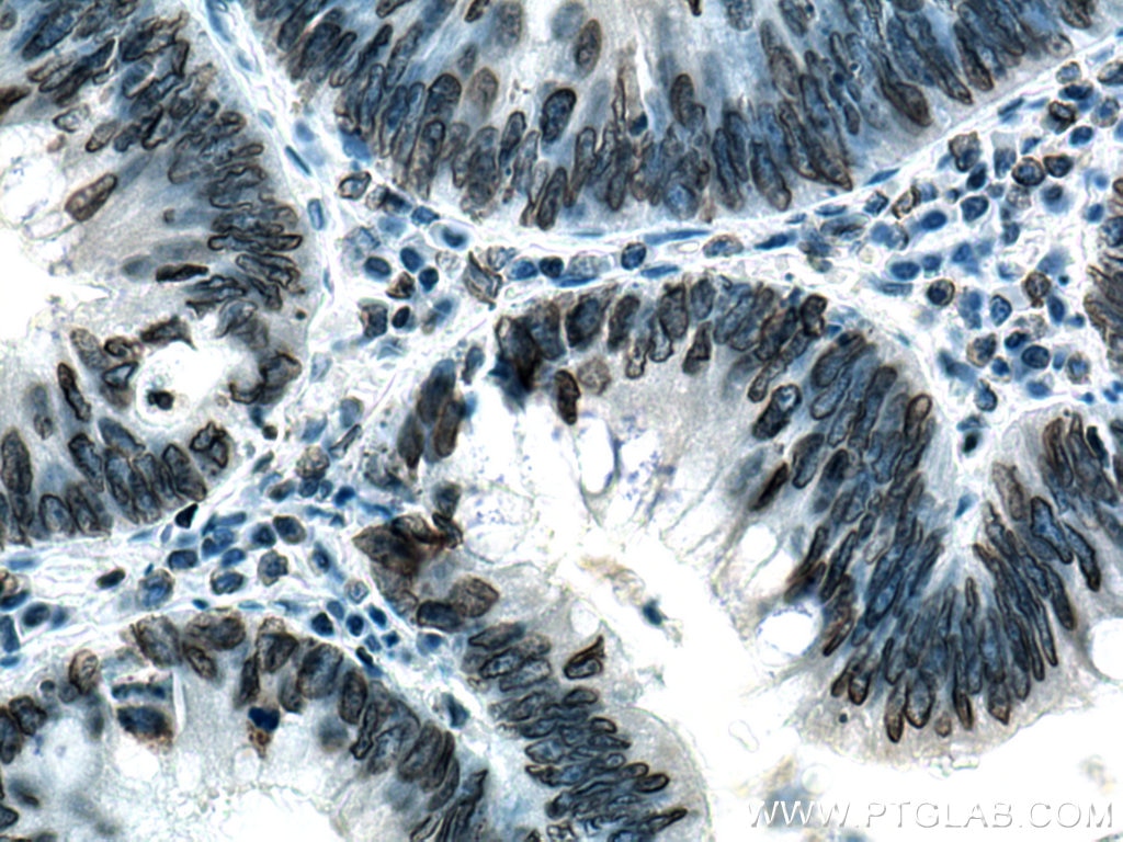 Immunohistochemistry (IHC) staining of human colon cancer tissue using Lamin B1 Polyclonal antibody (12987-1-AP)