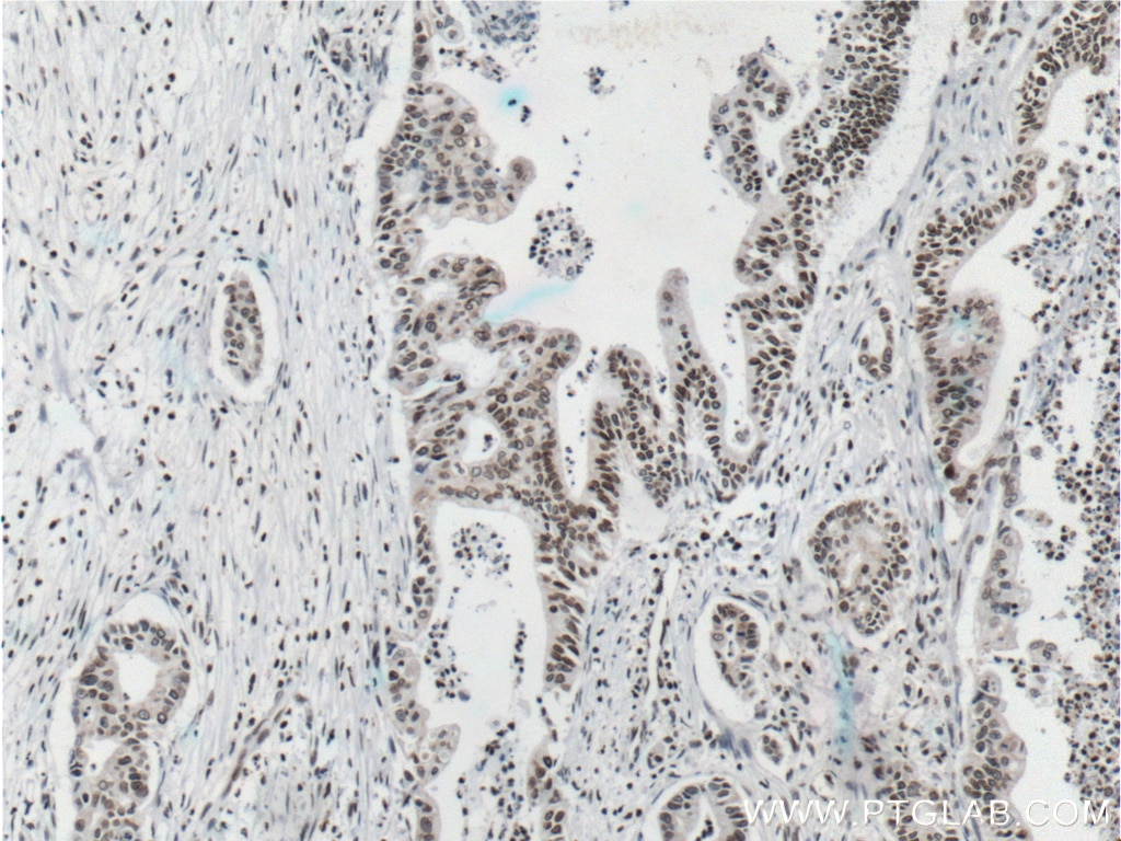 IHC staining of human pancreas cancer using 66095-1-Ig