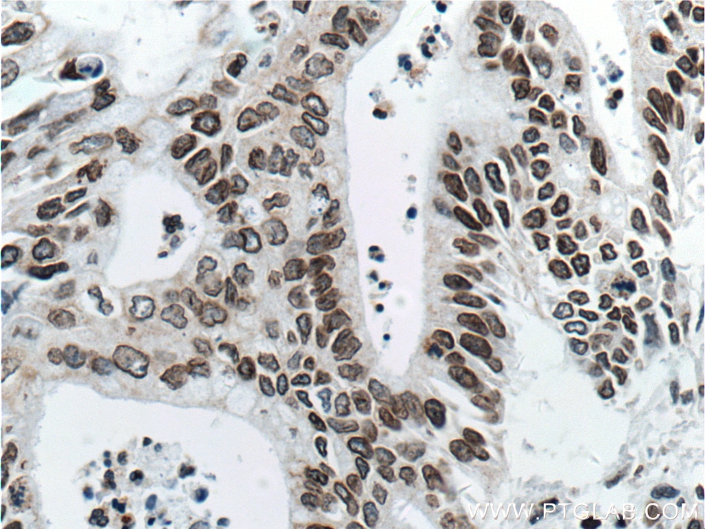 Immunohistochemistry (IHC) staining of human pancreas cancer tissue using Lamin B1 Monoclonal antibody (66095-1-Ig)