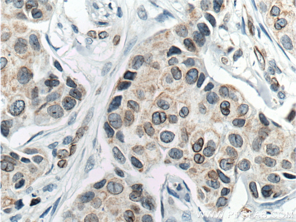 Immunohistochemistry (IHC) staining of human breast cancer tissue using Lamin B1 Monoclonal antibody (66095-1-Ig)