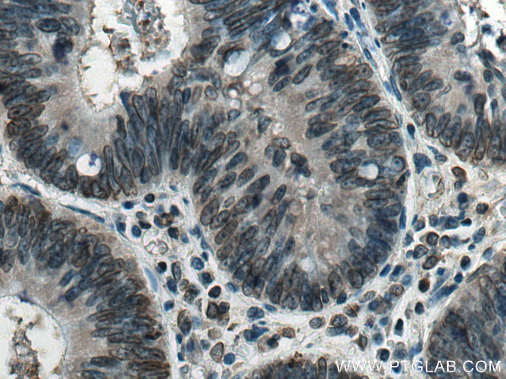 Immunohistochemistry (IHC) staining of human colon cancer tissue using Lamin B2 Polyclonal antibody (10895-1-AP)