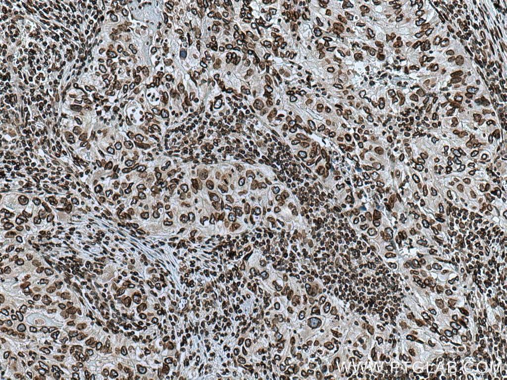 Immunohistochemistry (IHC) staining of human lung cancer tissue using Lamin B2 Polyclonal antibody (10895-1-AP)