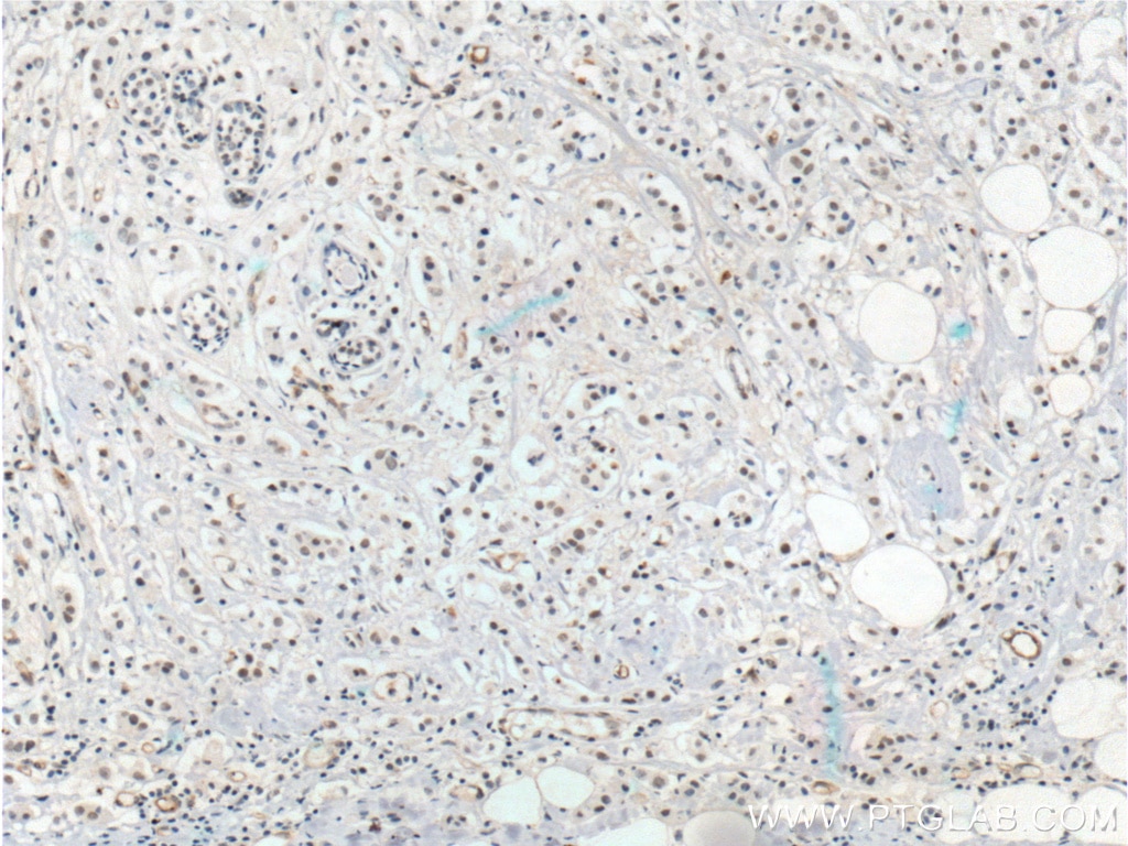 Immunohistochemistry (IHC) staining of human breast cancer tissue using LMTK3 Polyclonal antibody (22899-1-AP)