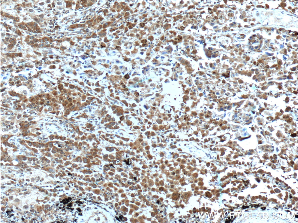 Immunohistochemistry (IHC) staining of human lung cancer tissue using LMTK3 Polyclonal antibody (22899-1-AP)