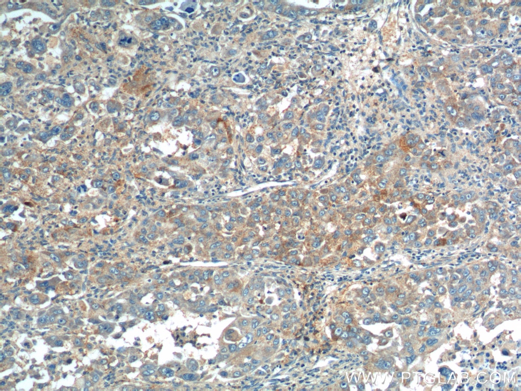Immunohistochemistry (IHC) staining of human liver cancer tissue using ANGPTL8/Betatrophin Polyclonal antibody (23792-1-AP)