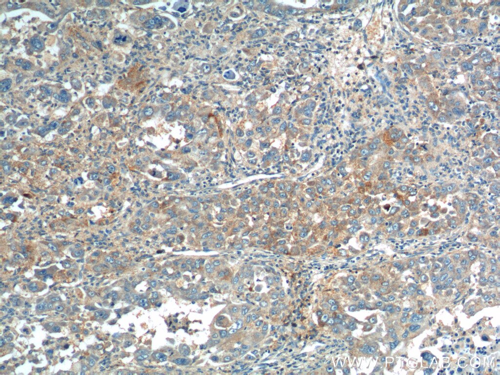 Immunohistochemistry (IHC) staining of human liver cancer tissue using ANGPTL8/Betatrophin Polyclonal antibody (23792-1-AP)